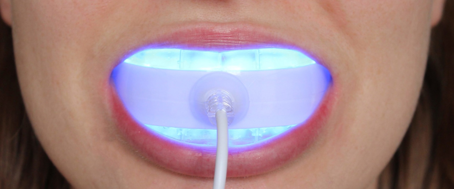 Are Teeth Whitening Lights Safe? An Expert's Perspective