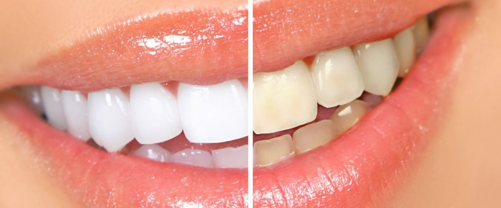 How Much Does Teeth Whitening Cost?