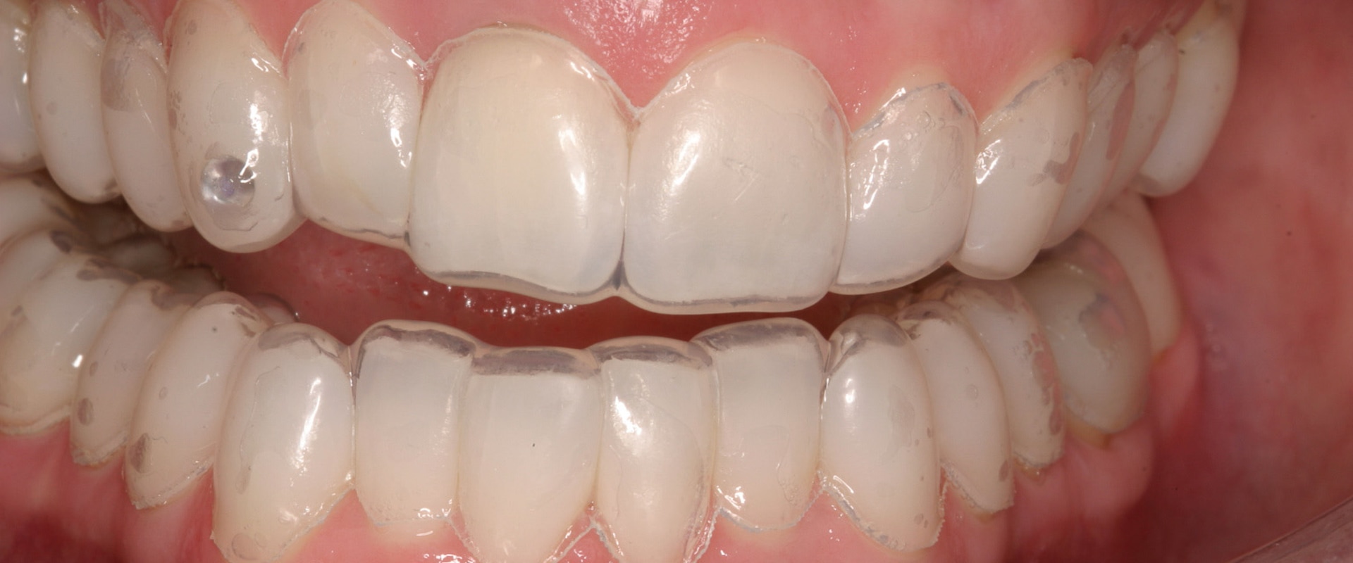 What Teeth Whitening Solutions Do Dentists Use?