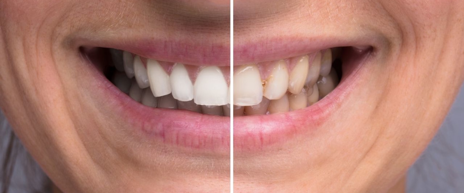 Does Teeth Whitening Cause LongTerm Damage?