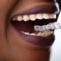 Which Teeth Whitening Gel is the Best Choice for You?