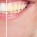 The Benefits of Teeth Whitening: A Comprehensive Guide