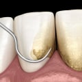 Does Teeth Whitening Remove Tartar?