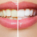 How to Achieve a Perfect White Smile with Teeth Whitening