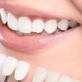 Everything You Need to Know About Teeth Whitening