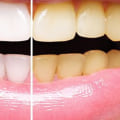 When Does Teeth Whitening Work? A Comprehensive Guide