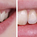 Can Teeth Whitening Damage Your Teeth? An Expert's Perspective