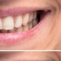 Why Teeth Whitening Doesn't Always Work