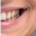 Does Teeth Whitening Cause Long-Term Damage?