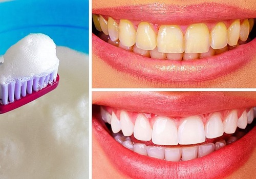 How to Whiten Teeth at Home
