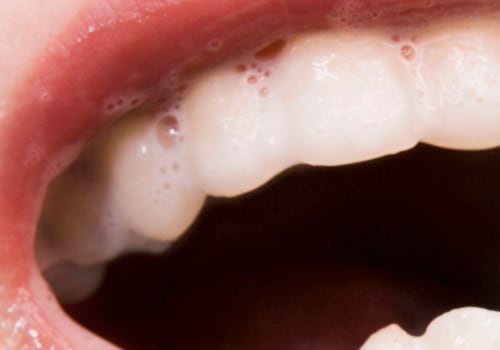 5 Myths About Teeth Whitening and the Truth Behind Each One