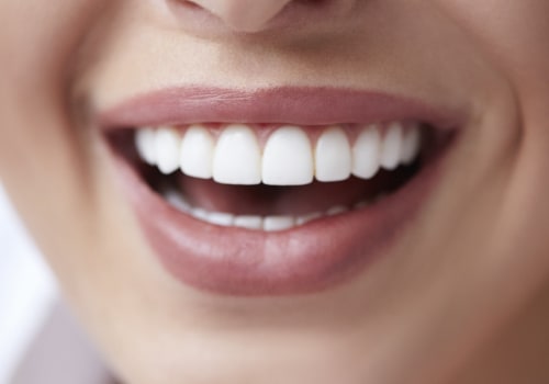 Will Teeth Whitening Damage Crowns? Expert Advice on the Topic