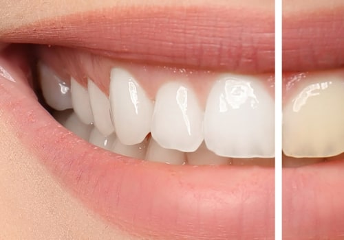 Do Whitening Strips Work on Yellow Teeth?
