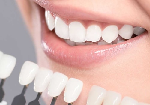 Everything You Need to Know About Teeth Whitening