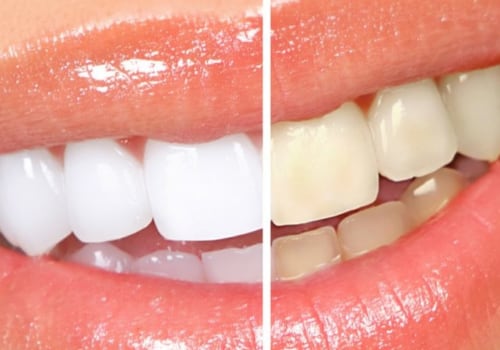 How Much Does Teeth Whitening Cost?