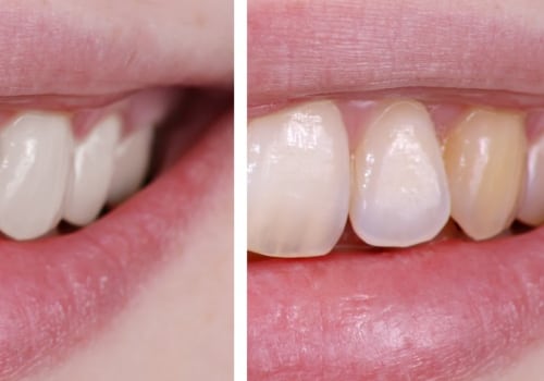 Can Teeth Whitening Damage Your Teeth? An Expert's Perspective