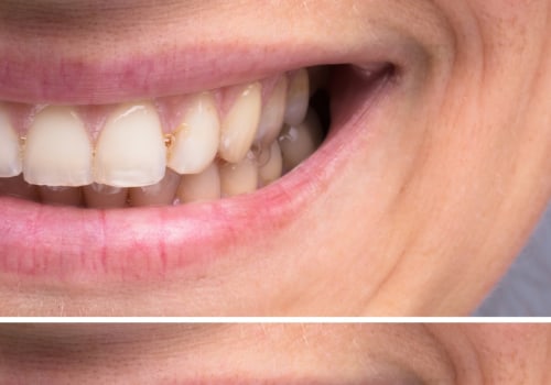 Why Teeth Whitening Doesn't Always Work